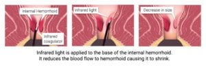 Hemorrhoid Treatment Specialist Nyc 