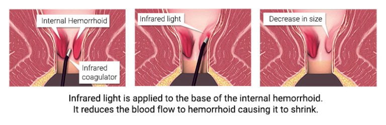 Hemorrhoid Treatment Specialist Nyc New York City Hemorrhoid Doctor