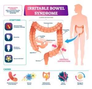 Irritable Bowel Syndrome Treatment NYC | Top IBS Doctors UES