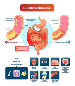 Best Crohn’s Disease Treatment Doctors Upper East Side, NYC