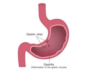 Peptic Ulcers Doctor NYC |Top NYC Gastroenterologist