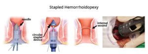 hemorrhoids stapled hemorrhoidopexy