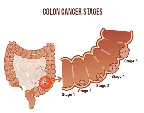 Colon Cancer Awareness Month - Manhattan Gastroenterology