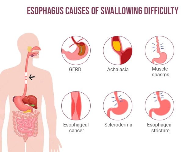 Swallowing Issues Gastroenterologists In Nyc Dysphagia Treatment