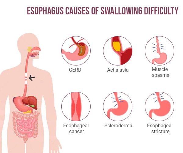 Swallowing Issues Gastroenterologists In NYC Dysphagia Treatment