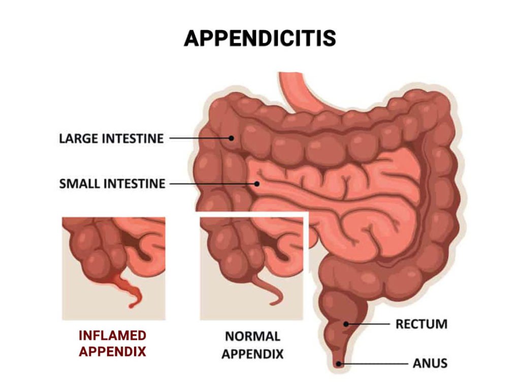 Possible Causes of Lower Right Abdomen Pain - Manhattan Gastroenterology