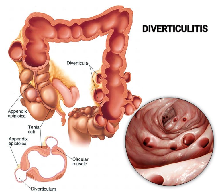 lower-left-abdominal-pain-manhattan-gastroenterology