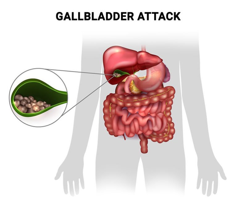 gallbladder trauma due to car accident signs