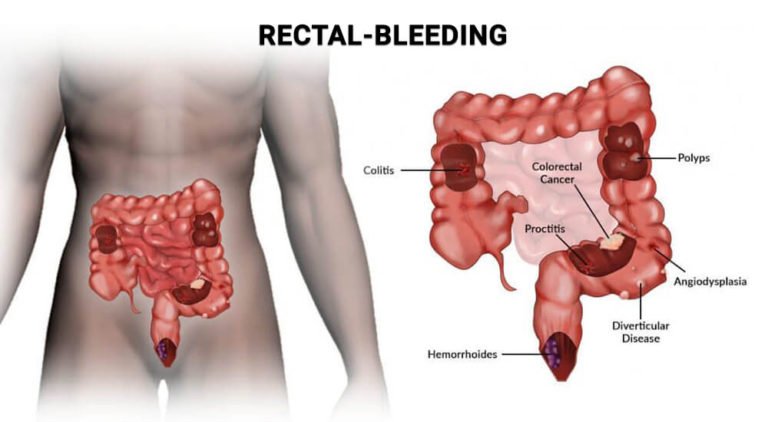 When Should I Worry About Bright Red Blood In My Stool