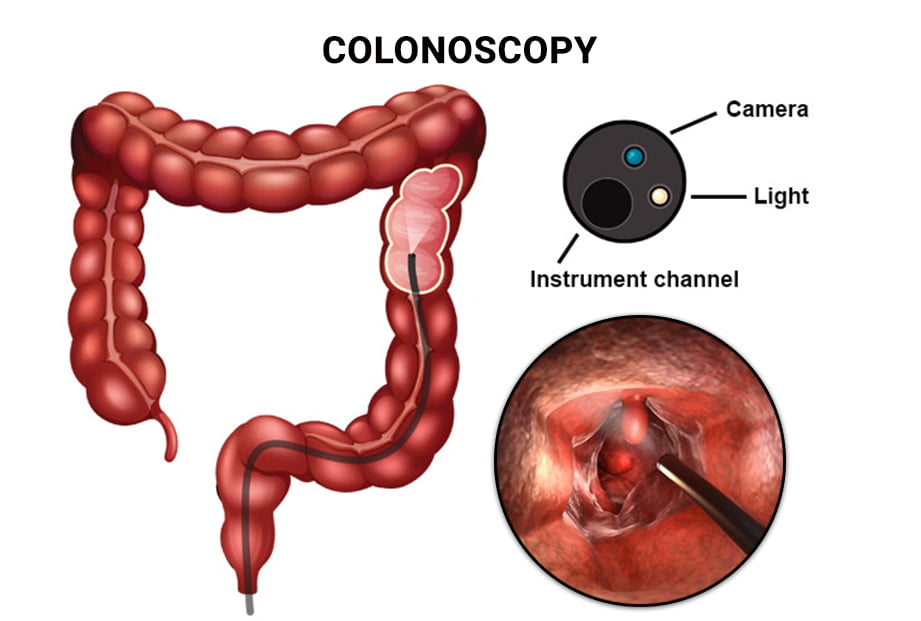 How Do I Know When Colonoscopy Prep Is Complete?