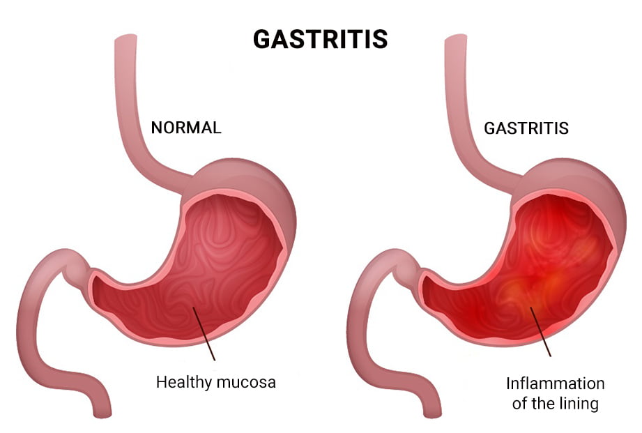 Why Does My Stomach Burn After I Eat Manhattan Gastroenterology