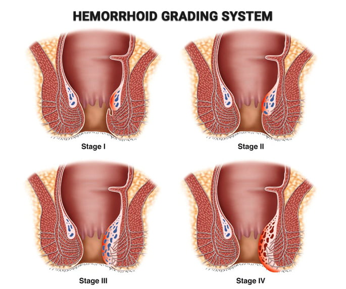 stage ii hemorrhoids internal