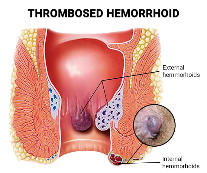 prolapsed hemorrhoid vs external