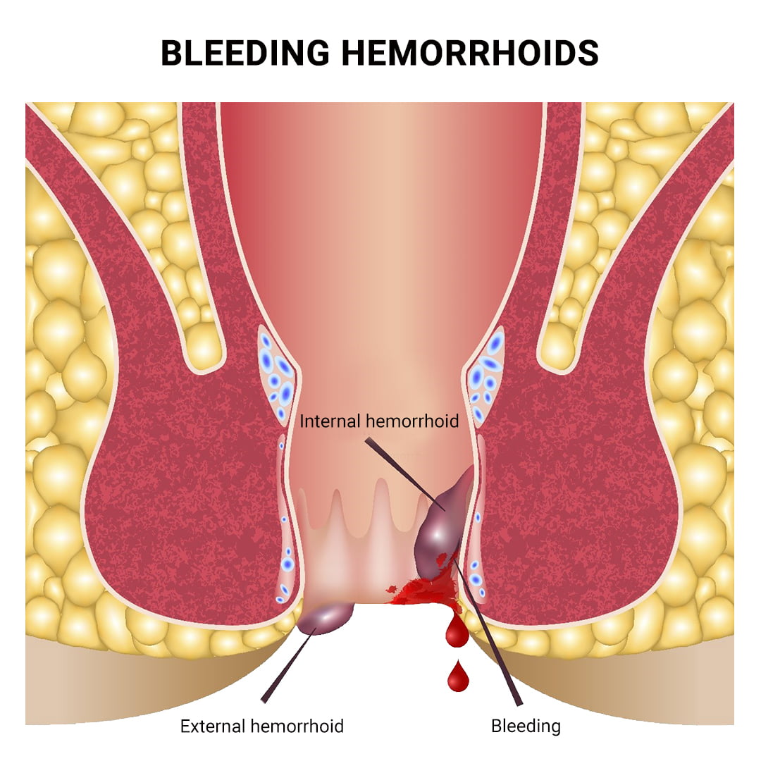 internal hemorrhoid swelling